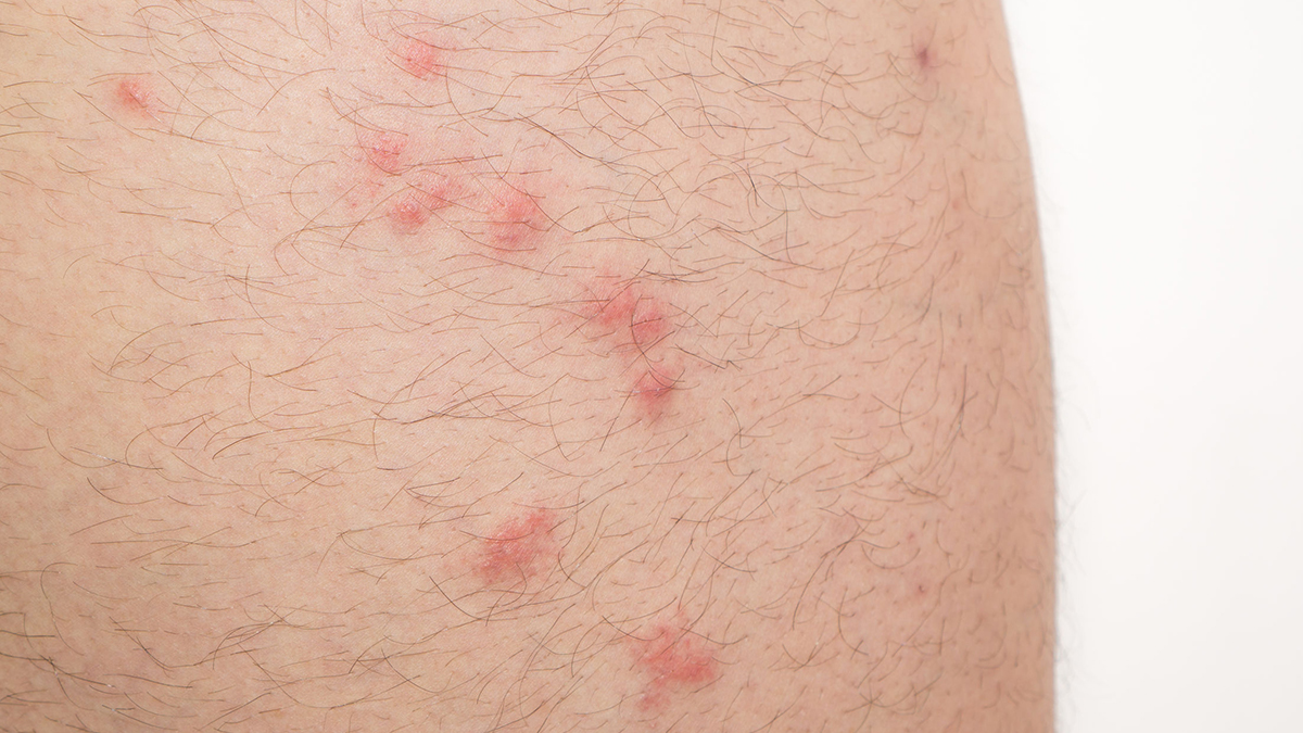 615 flea bites The typical symptom of a flea bite is a small red spot about 5mm in diameter.